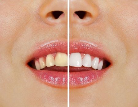 depositphotos_13474400-stock-photo-teeth-before-and-after-whitening-transformed